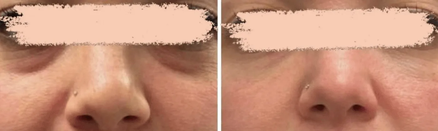 Full face before and after