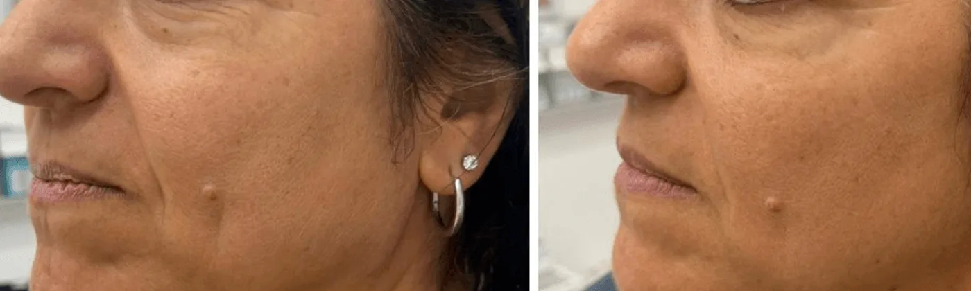 Eye and cheek area before and after