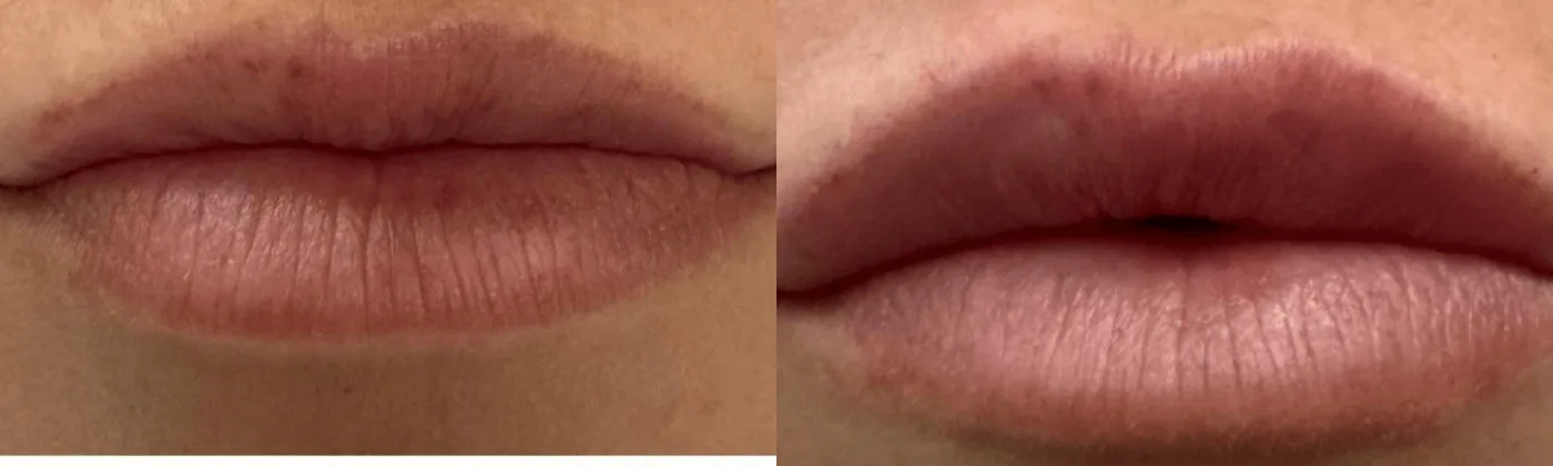 Lip filler before and after