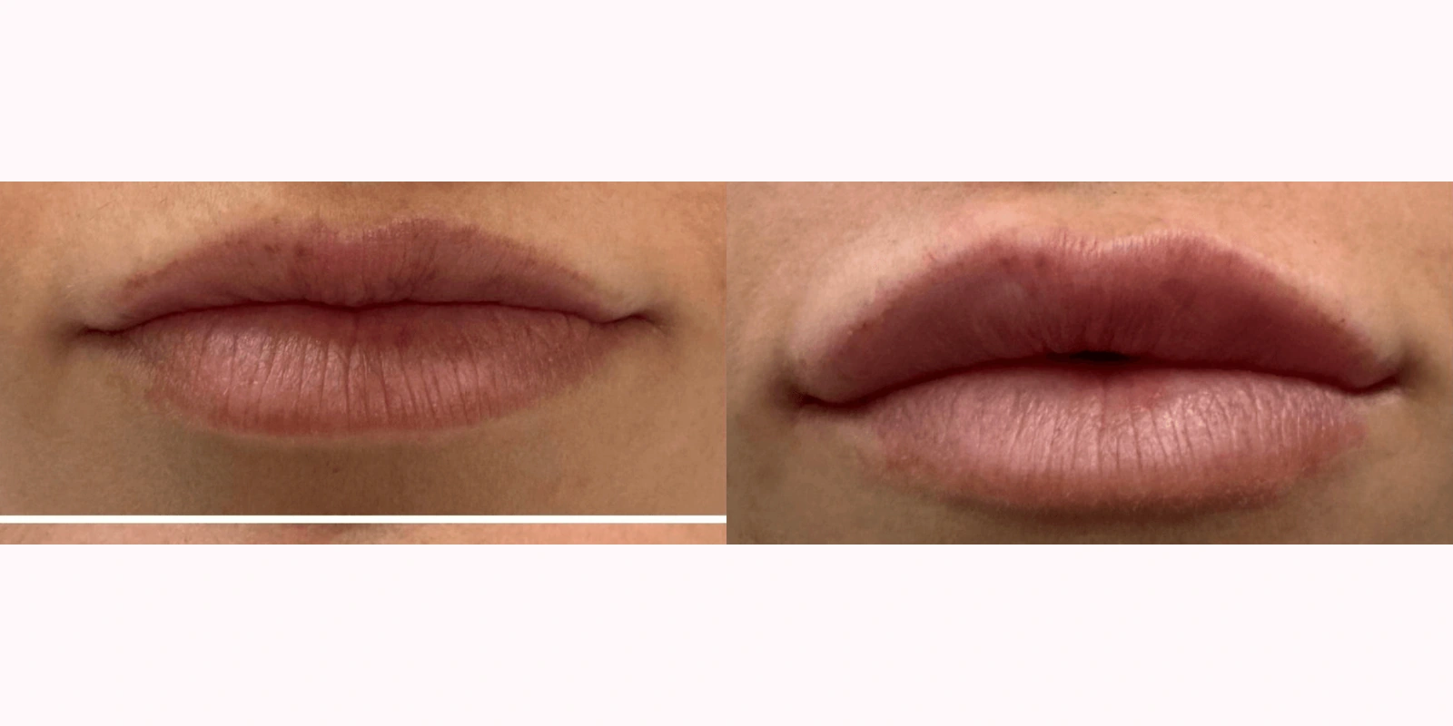 THEA before and after example 1