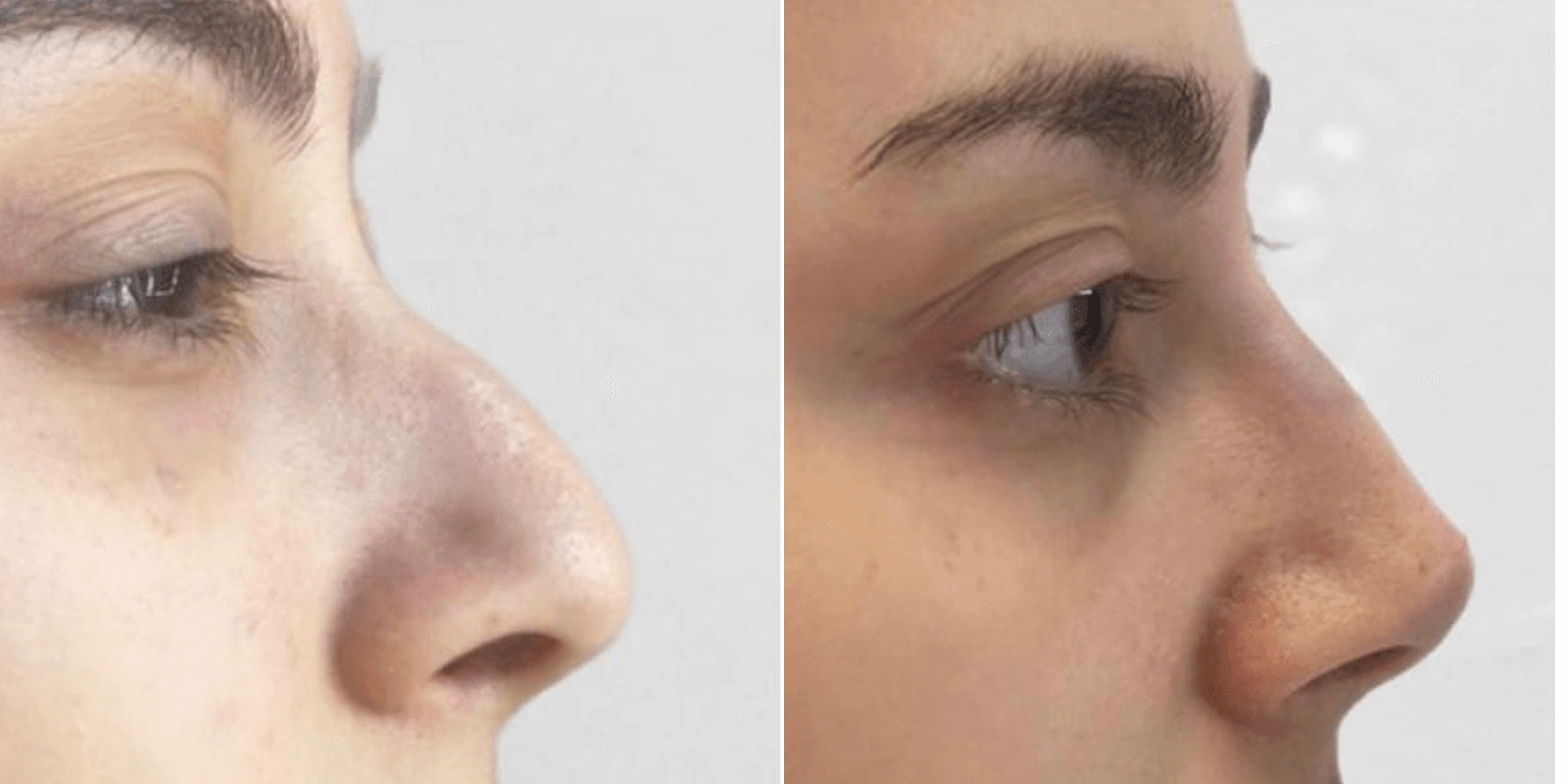 THEA before and after example 3
