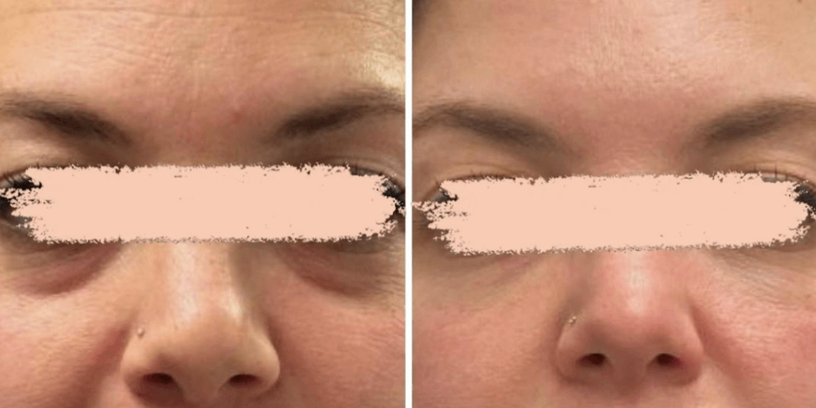 THEA before and after example 4