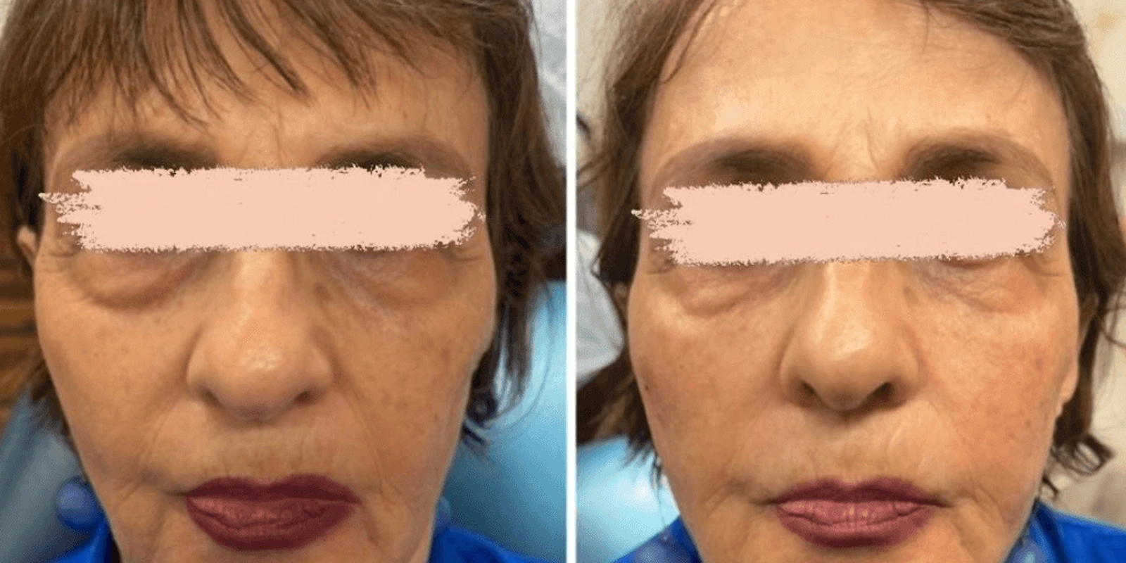 THEA before and after example 5