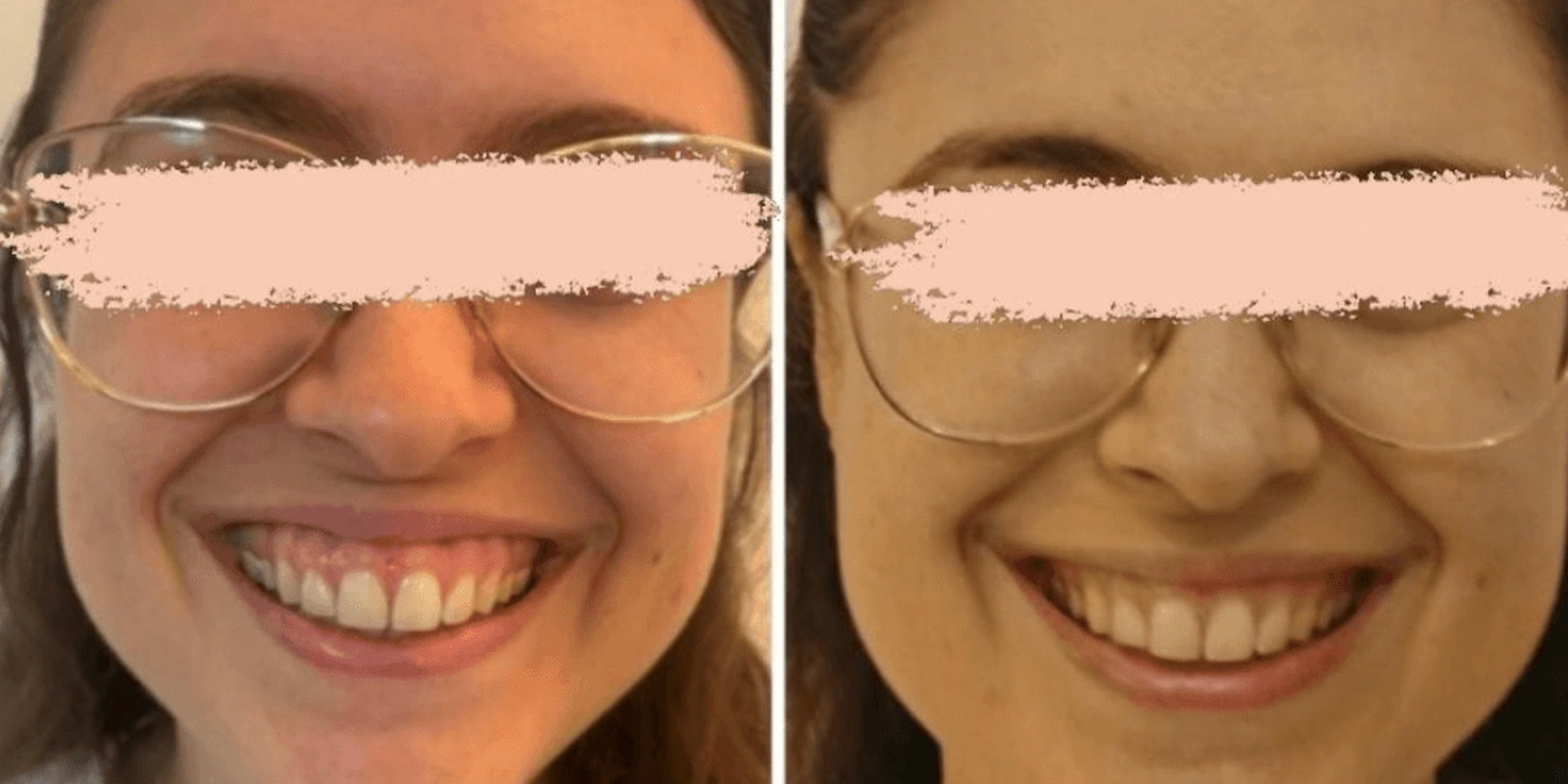 THEA before and after example 6