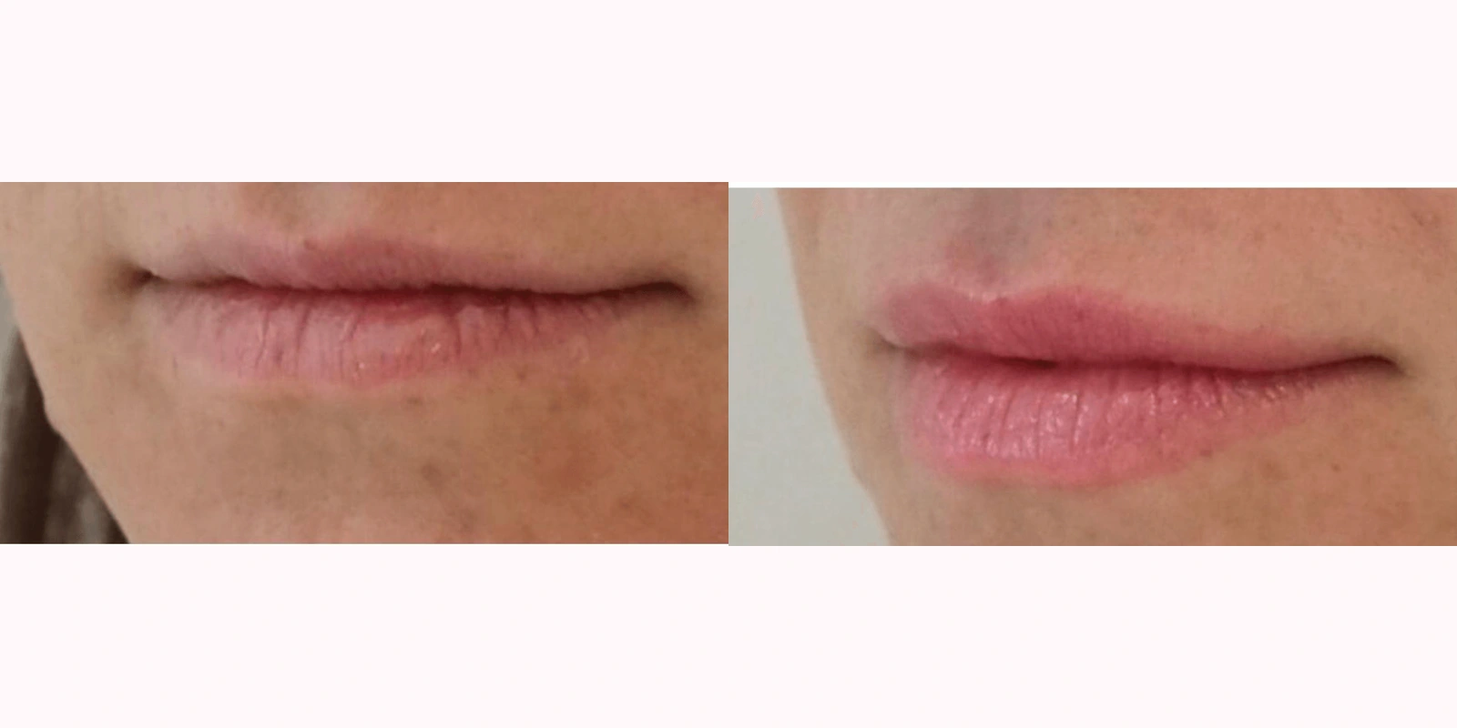THEA before and after example 8