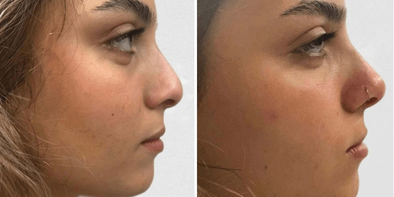 THEA before and after example 9