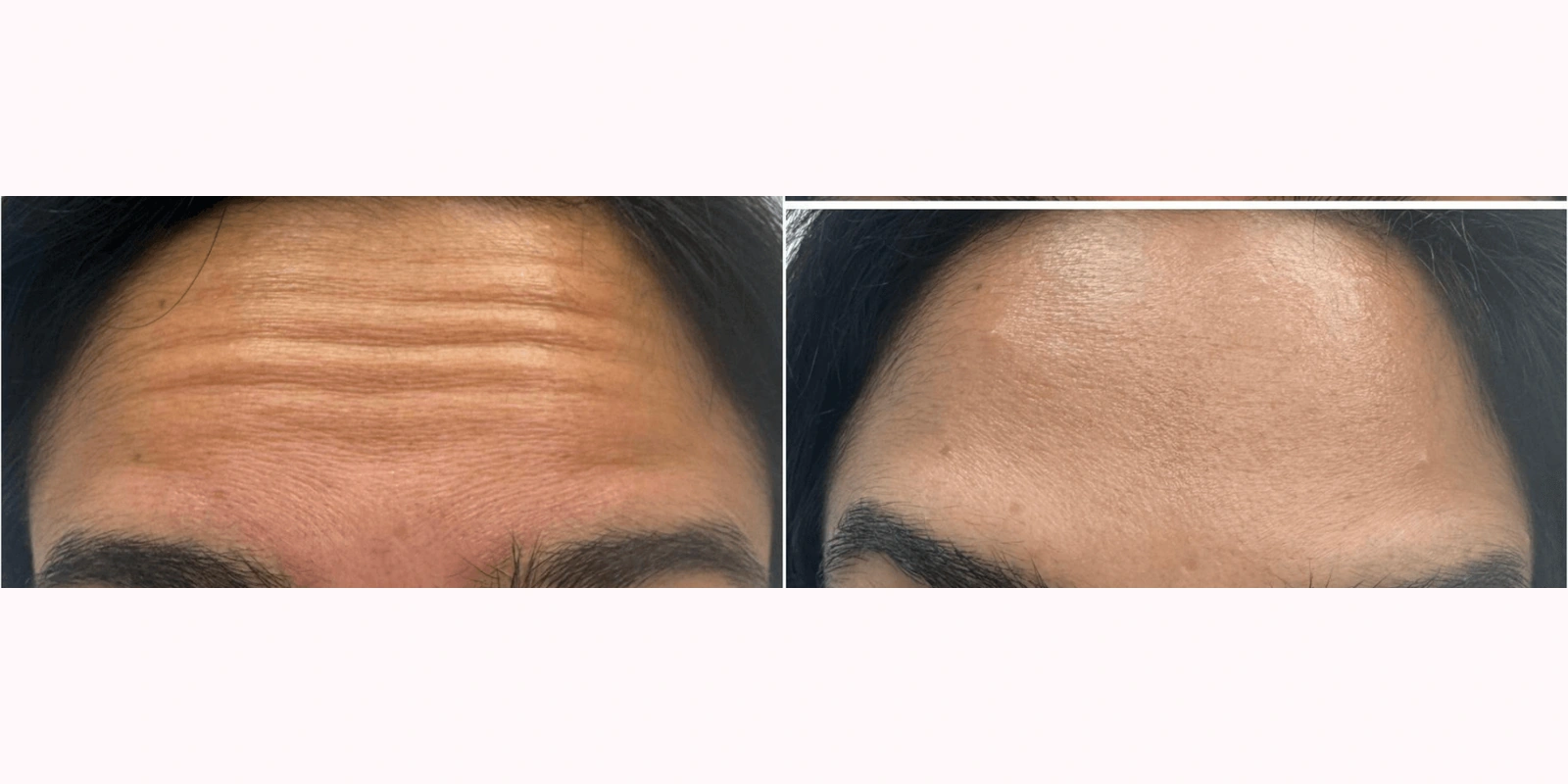 THEA before and after example 10